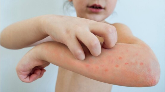 The city hall in Western Santa Catarina reported an outbreak of chickenpox in public public schools.