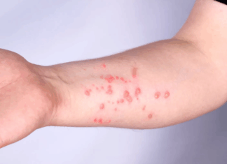 Porto Alegre confirma primeiro caso de Mpox em 2026