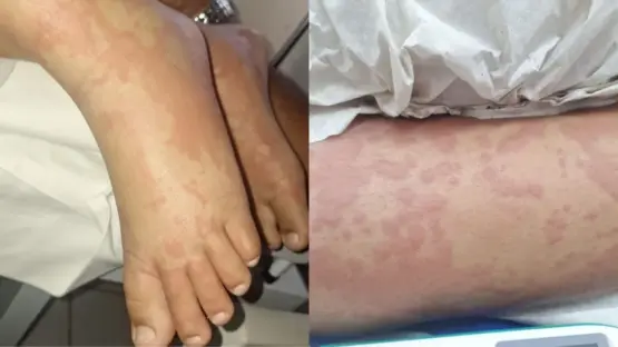 Criança é internada após suspeita de contaminação ligada a detergente