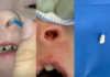 Inusitado: dentista descobre dente intranasal em menina de 3 anos