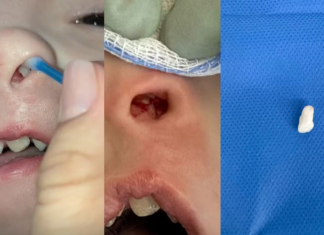 Inusitado: dentista descobre dente intranasal em menina de 3 anos
