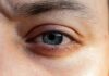 Transplante inédito de retina devolve visão a italiana que estava cega há cinco anos