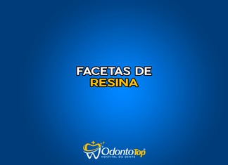 #193 Facetas de Resina