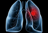 Saiba o que é adenocarcinoma pulmonar, câncer que atinge o papa